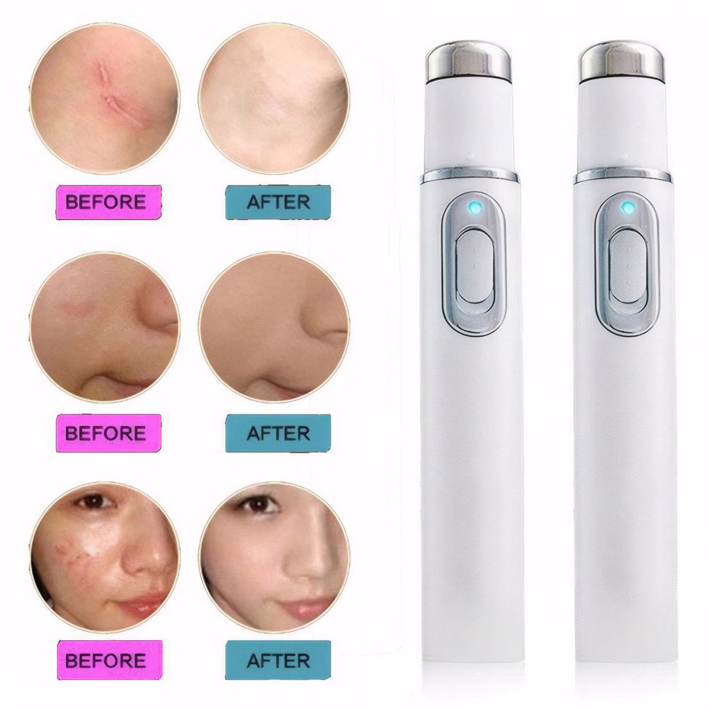 Terapia de luz azul, pluma LED - Acne Light Therapy Pen reseña y precio