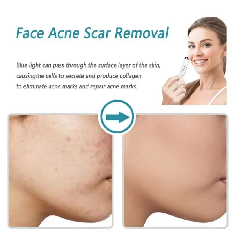 Terapia de luz azul, pluma par - Acne Light Therapy Pen reseña y precio